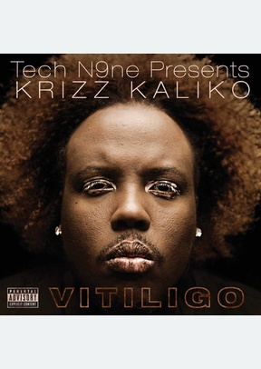 Vitiligo